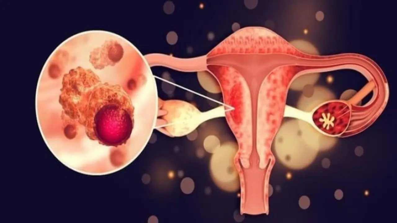 https://www.mobilemasala.com/health-hi/Important-aspects-to-consider-when-facing-the-diagnosis-of-ovarian-cancer-you-should-also-know-hi-i295109