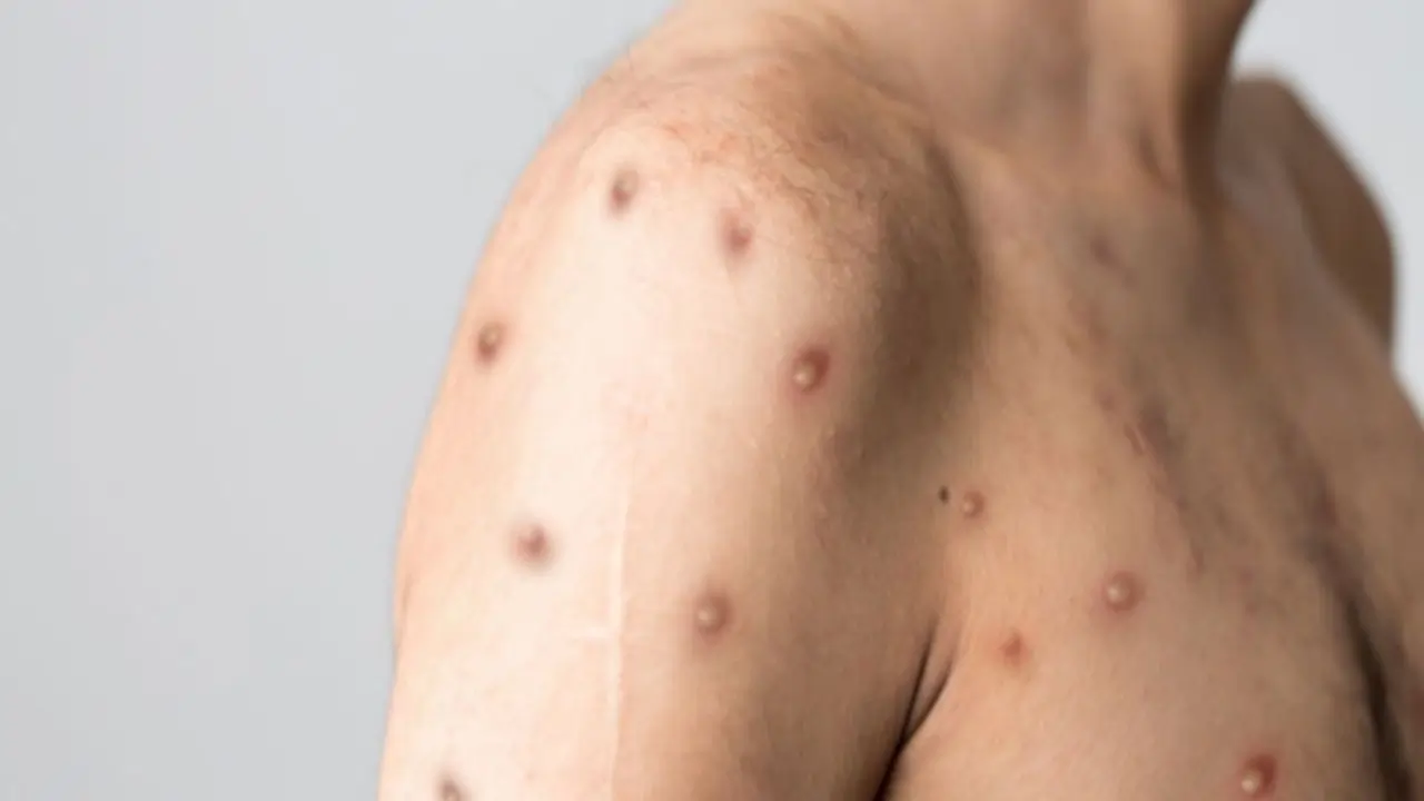 https://www.mobilemasala.com/health-hi/Important-guidelines-for-monitoring-and-management-of-monkeypox-you-should-also-know-hi-i292458